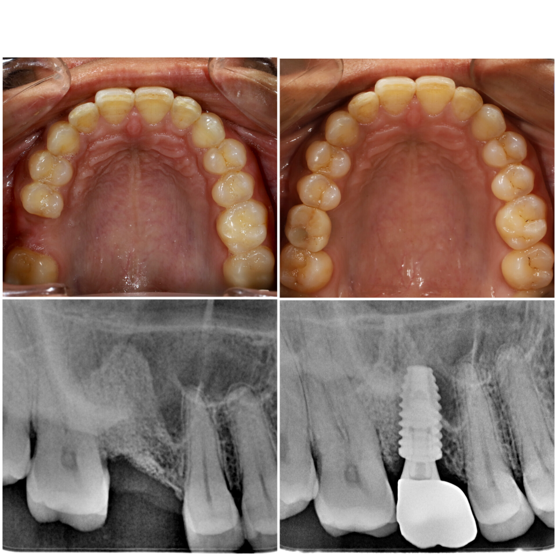 Dental Implants