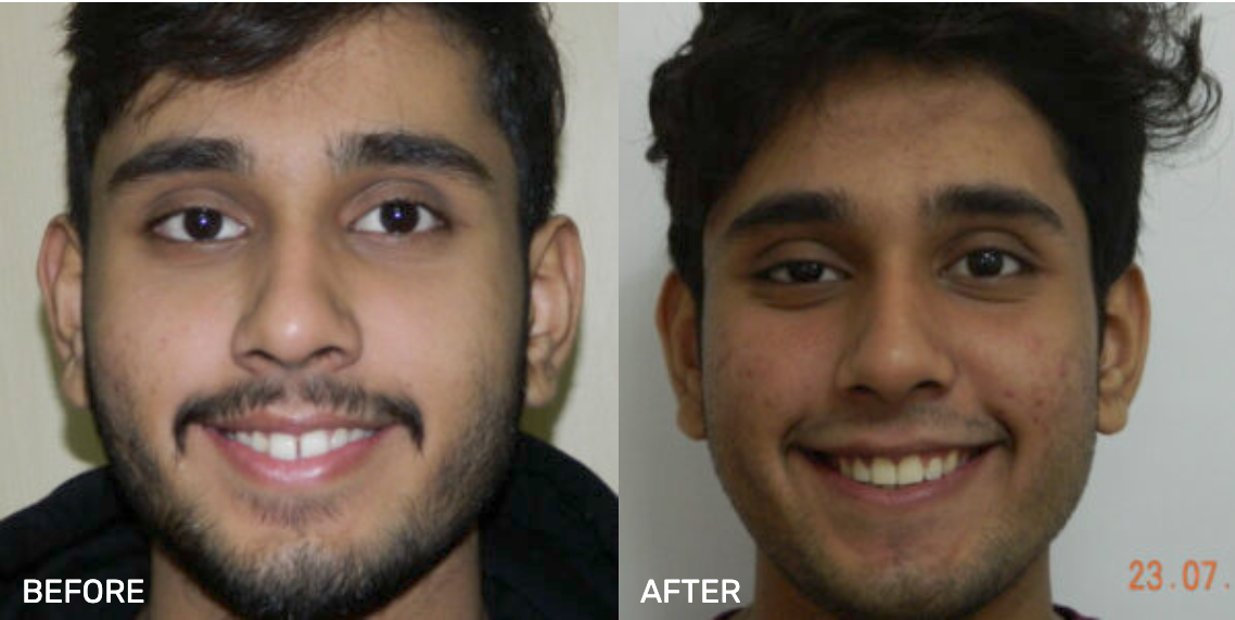 Before After