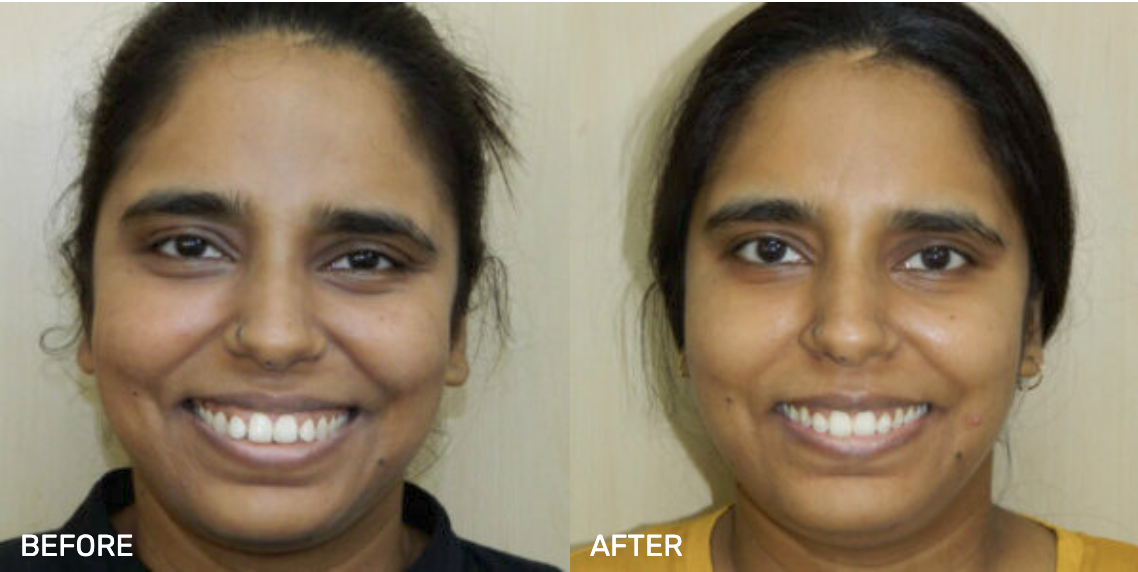 Before After