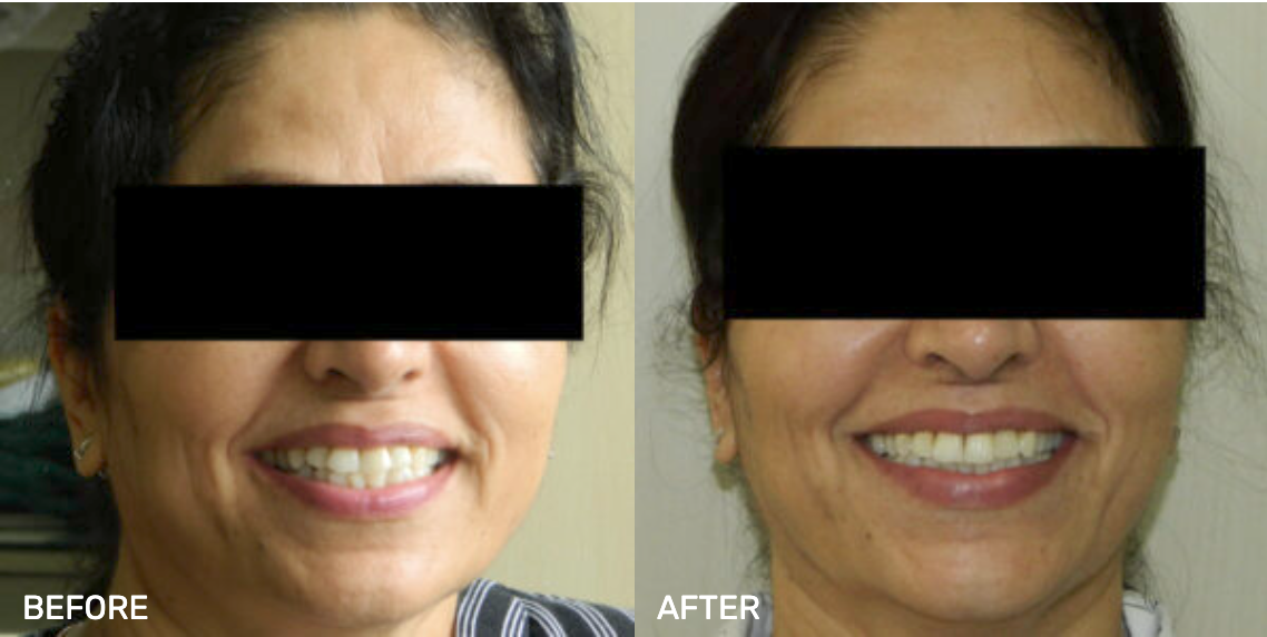 Before After